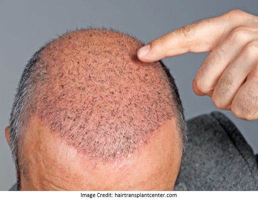 hair-transplant-surgery
