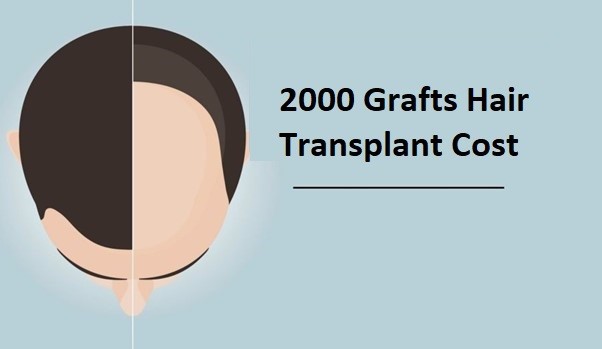 2000 Grafts Hair Transplant