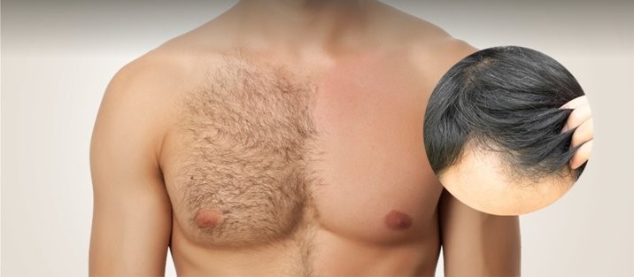 body hair transplant