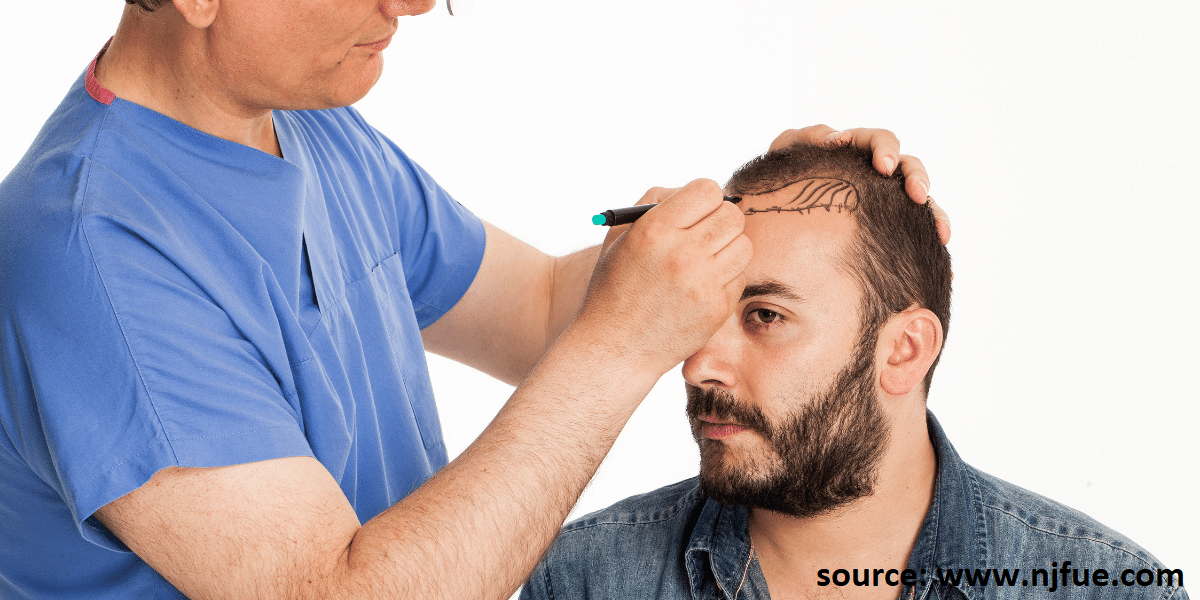 Stem Cell Hair Transplant