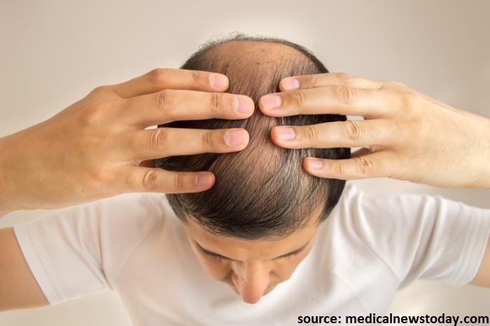 Testosterone and Hair Loss