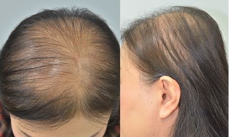 Female pattern hair loss